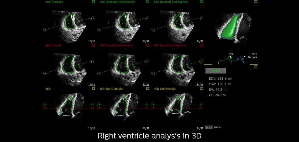 3.ª análise do ventrículo direito