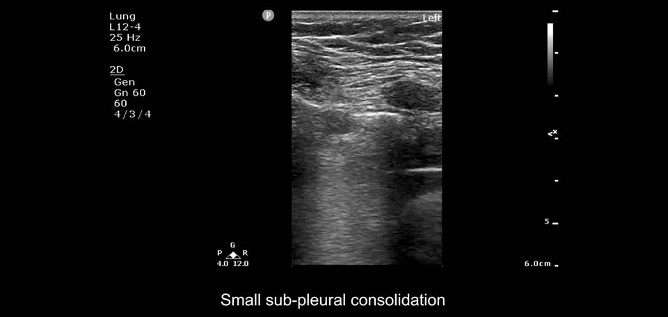 pequena consolidação subpleural