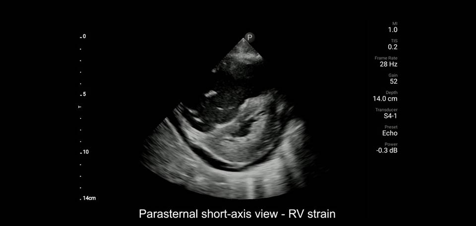 vista paraesternal de eixo curto – sobrecarga ventricular direita