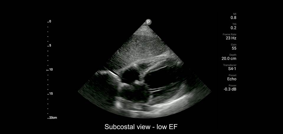 vista subcostal – FE baixa