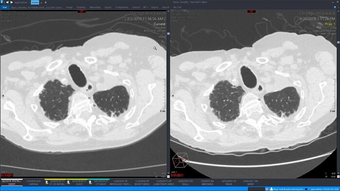 Demonstração do espaço de trabalho de radiologia único da Philips com visualização avançada