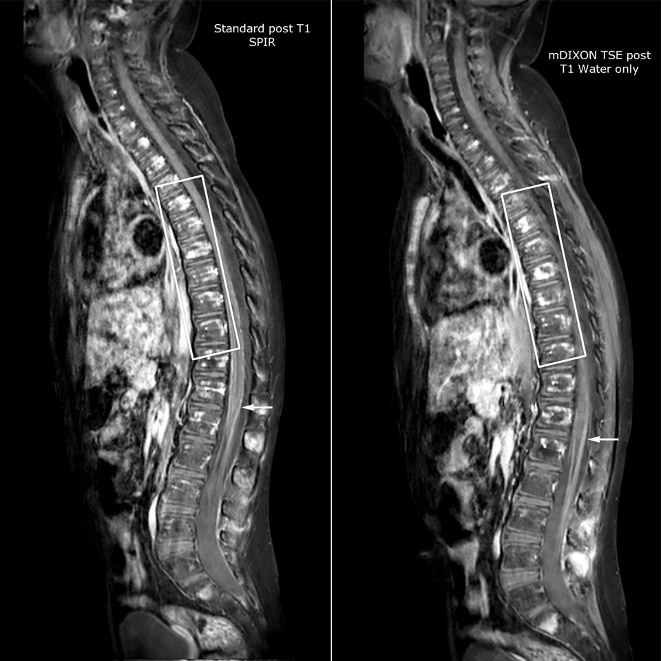 uma comparação da coluna vertebral de um paciente