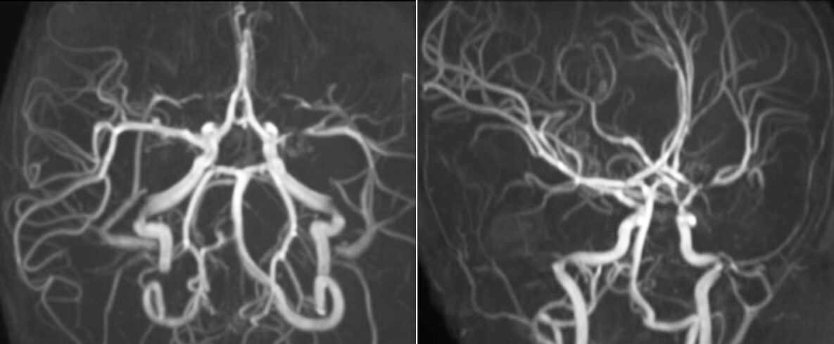 um grande plano de uma radiografia de um cérebro