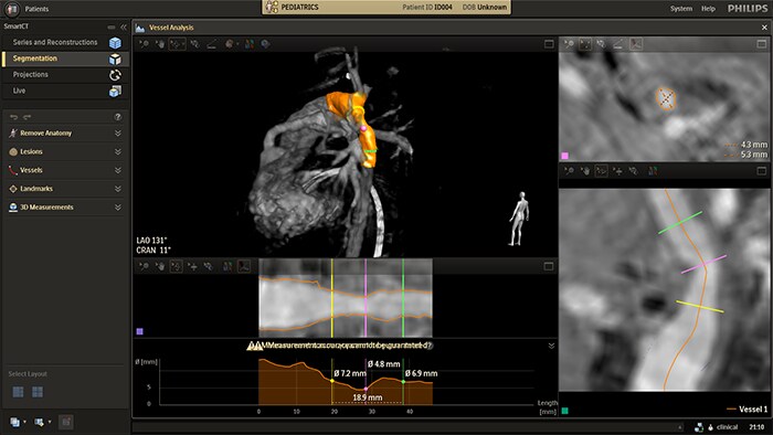 Análise automática dos vasos a partir da angiografia rotacional