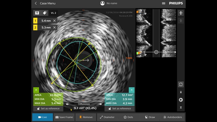 Ecografia intravascular (IVUS)