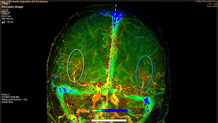 Perfusão de tecido SmartPerfusion com base em angiografia digital