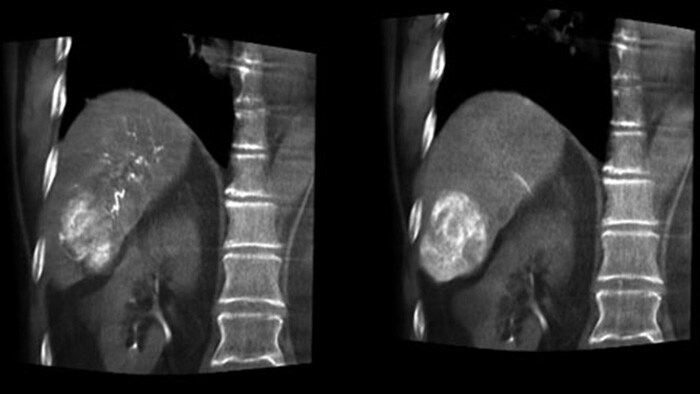 Visualização ideal da artéria e do tumor com CBCT Dual