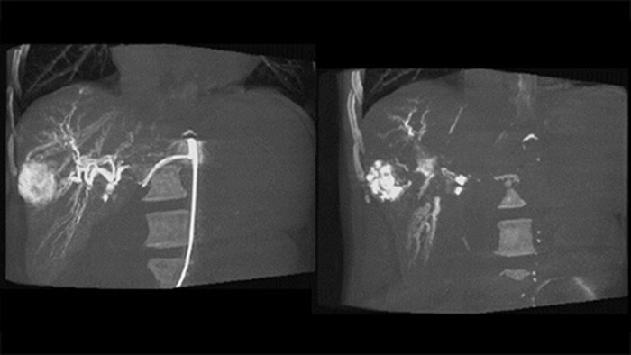 Imagens 3D pós-embolização com CBCT