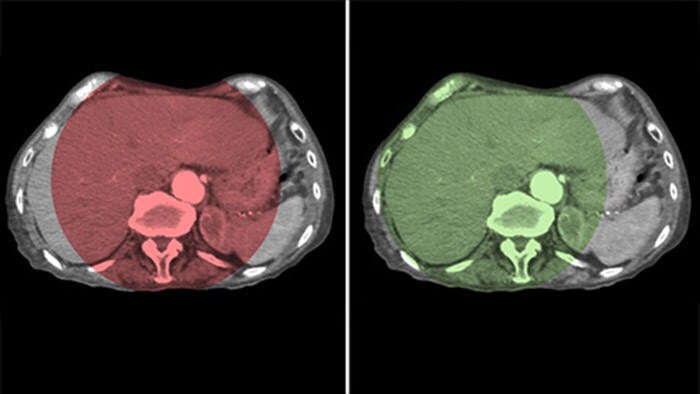 Cobertura total do fígado com CBCT aberta