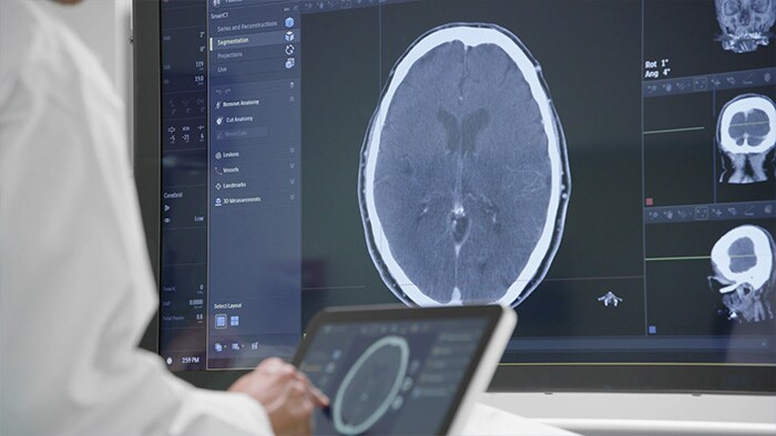 Tratamento de acidentes vasculares cerebrais isquémicos