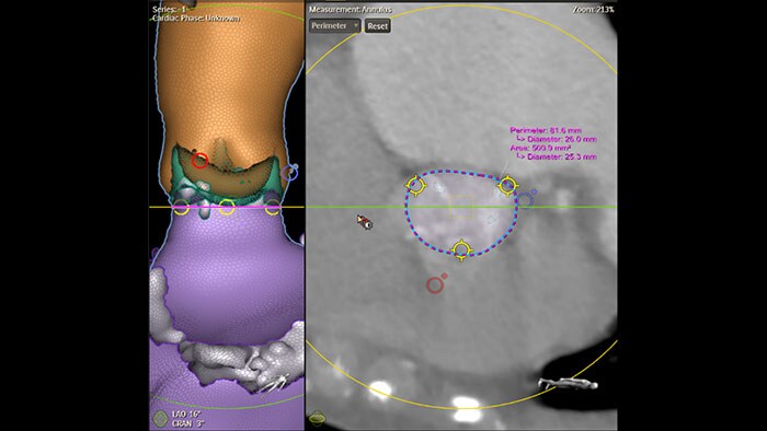 Imagem clínica, Philips HeartNavigator