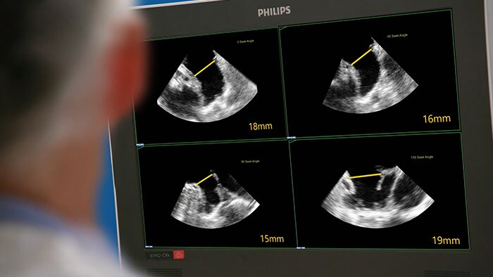 Sistema de ultrassons de intervenção do EPIQ CVxi
