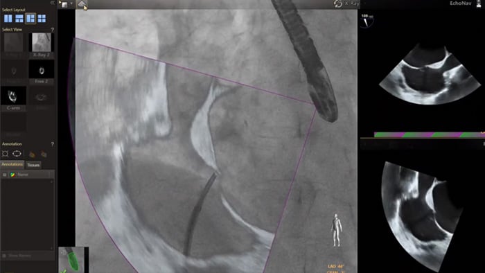 Modelos EchoNav, aorta mitral