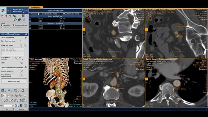 IntelliSpace Cardiovascular TAVI