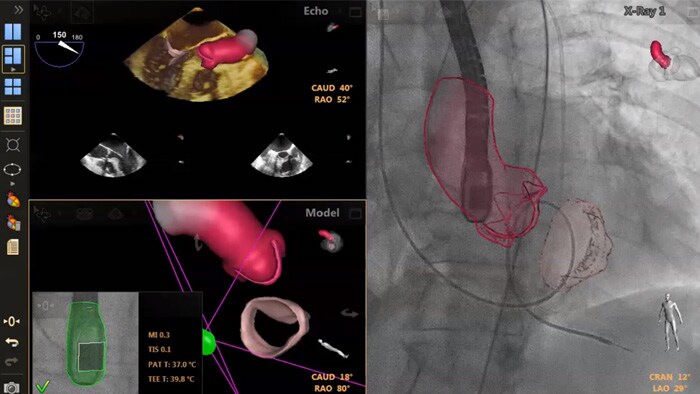 Orientação de punção transeptal