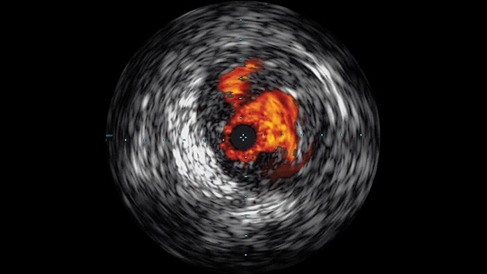 Ecografia intravascular (IVUS)