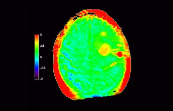 Cérebro com glioblastoma