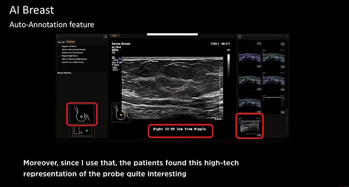 Tratamentos de alta tecnologia do cancro da mama