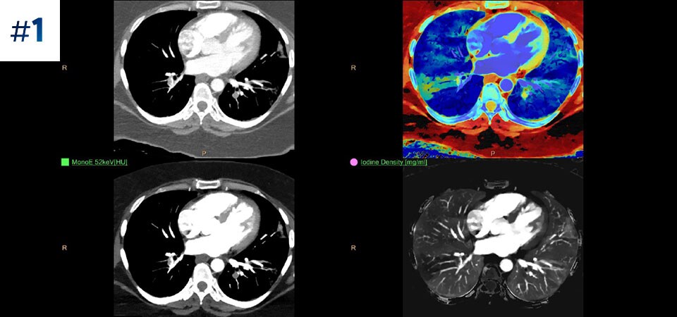 Para detetar embolia pulmonar