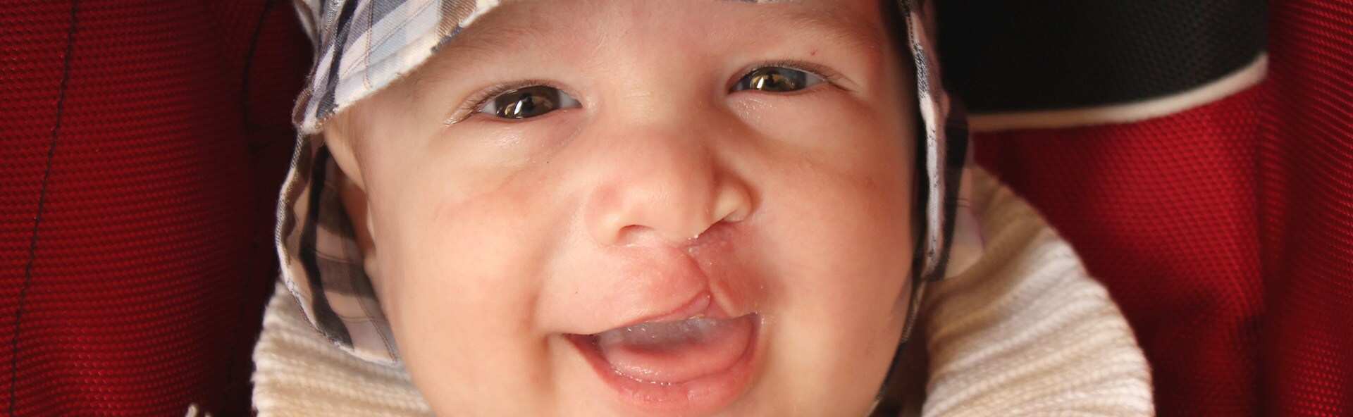 Alimentar o bebé após a reparação de lábio leporino