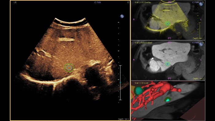 Tumor contour CEUS