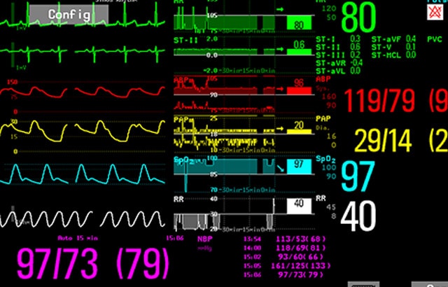 Image showing the Horizon Trends screen view in a patient monitor.