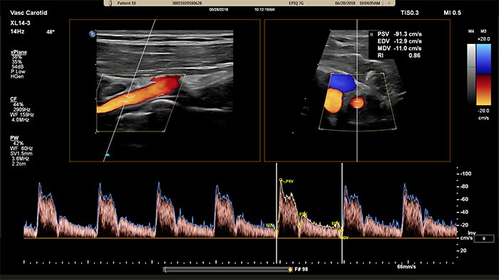 Exemplo de uma imagem recuperada com a ecografia vascular e Doppler xPlane da Philips