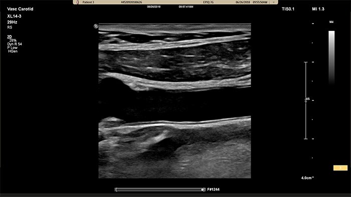 Exemplo de uma imagem recuperada com a ecografia vascular do transdutor linear XL14-3 xMATRIX da Philips