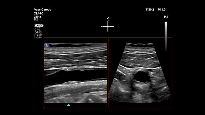 Exemplo de uma imagem recuperada com a ecografia vascular e imagens xPlane da Philips