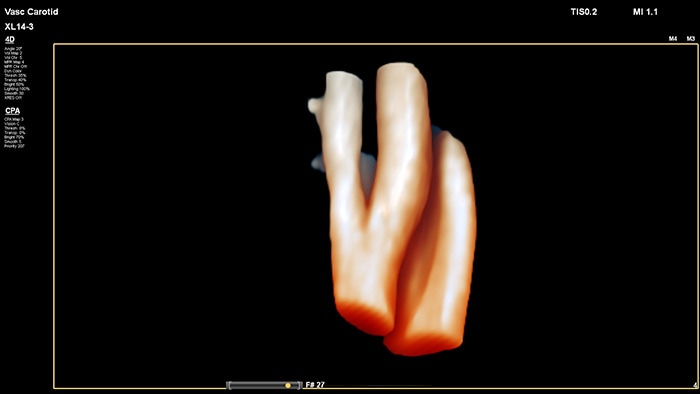 Exemplo de uma imagem 3D do molde do vaso recuperada com a ecografia vascular do transdutor linear XL14-3 xMATRIX da Philips