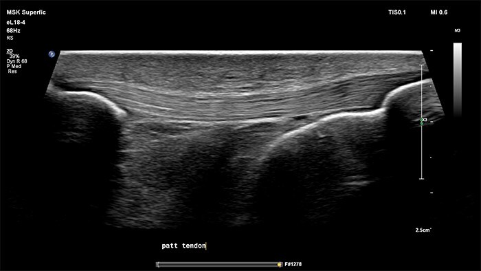 Knee patellar tendon