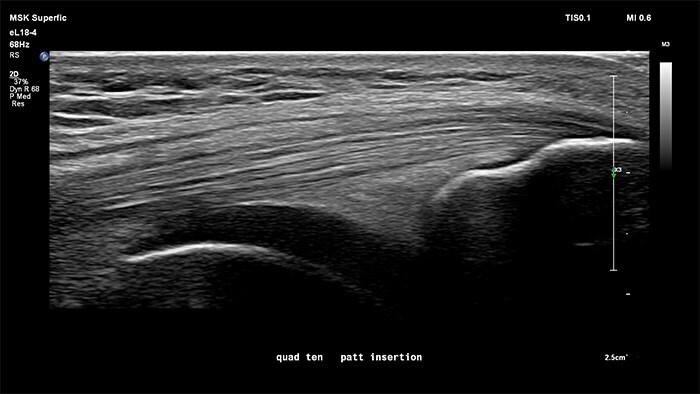 Knee quad ten patellar insert