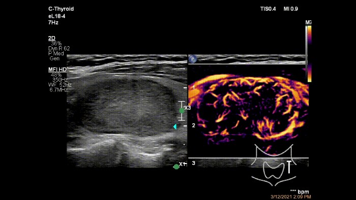 Epiq eL18 4 C thyroid MFI