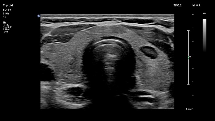 Epiq eL18 4 thyroid bilateral