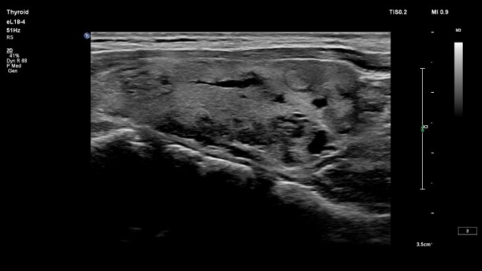 Epiq eL18 4 Thyroid