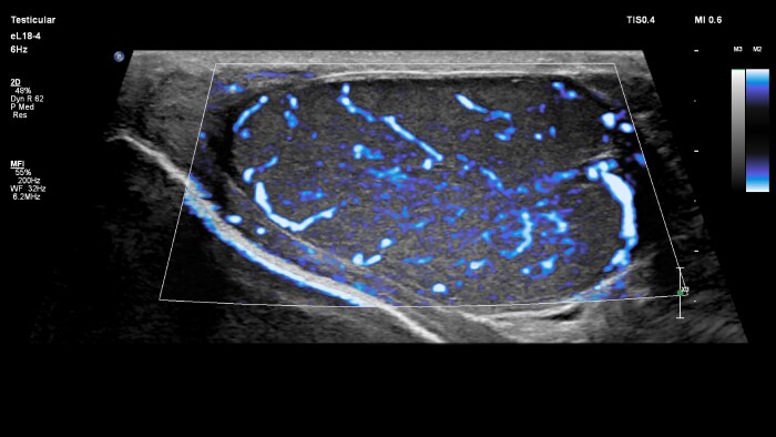 Epiq el18 4 testicle MFI