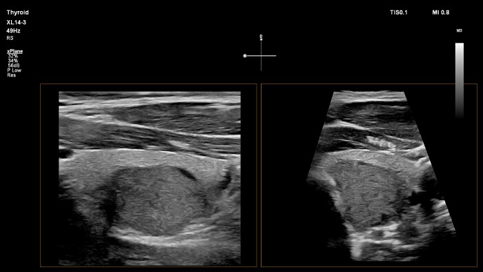 Epiq xL14 3 thyroid xPlane
