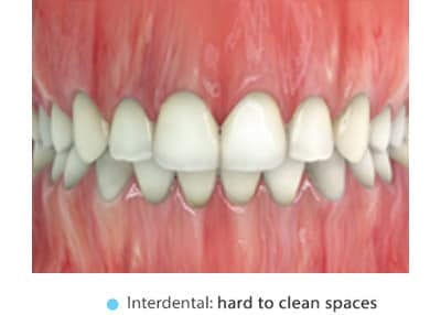 interdental hard to clean spaces
