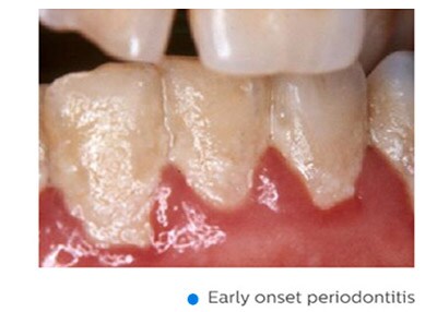 Periodontite em fase inicial