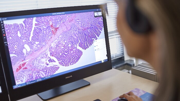La Unidad Intercentros de Anatomía Patológica de Granada valida e integra en su flujo de trabajo 100% digital, el primer algoritmo para el diagnóstico de Helicobacter pylori