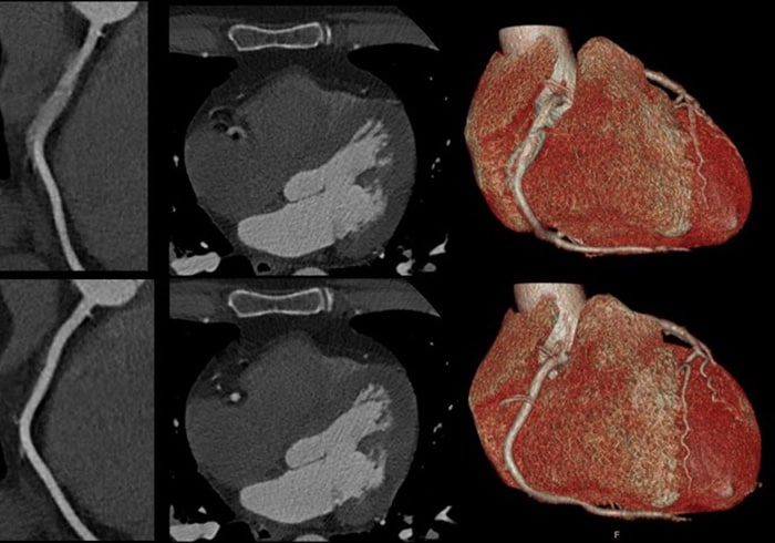 Download image (.jpg) Spectral CT 7500 Motion in Right Coronary Artery Comparison (abre em uma nova janela)