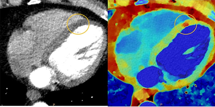 Download image (.jpg) Spectral CT 7500 Myocardial Perfusion Comparison (abre em uma nova janela)