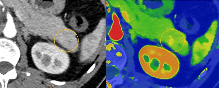 Download image (.jpg) Spectral CT 7500 Pancreatic Lesion Comparison (abre em uma nova janela)