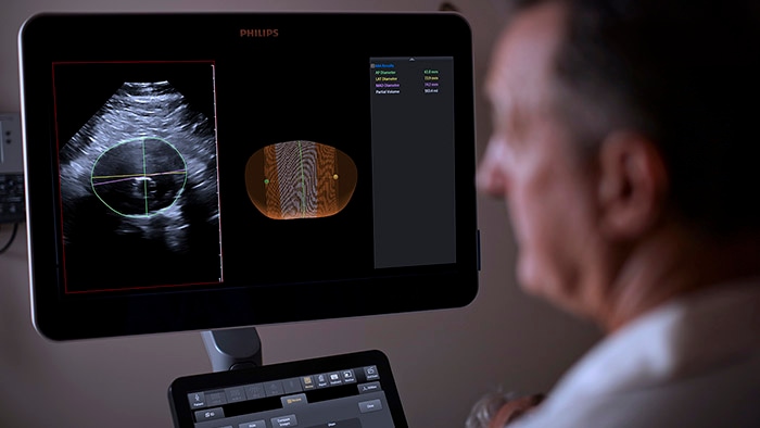 Philips integra ultrassom 3D com software inovador para avanço na vigilância de aneurismas da aorta abdominal